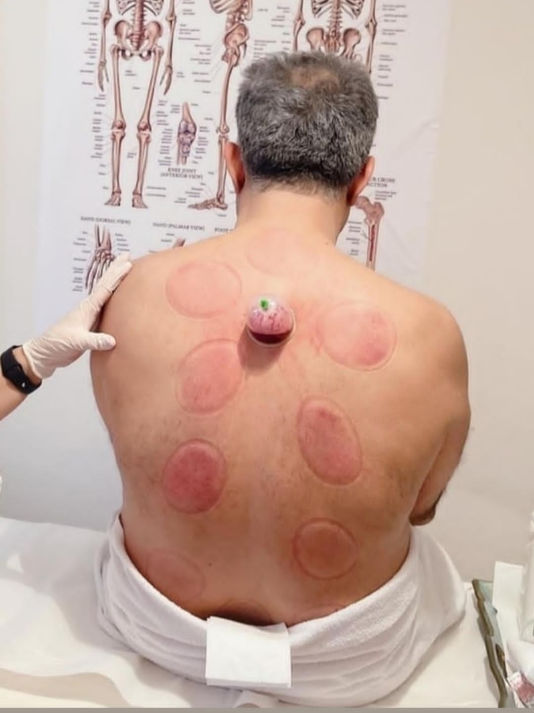 حجامت امبدینگ طب سوزنی در اصفهان