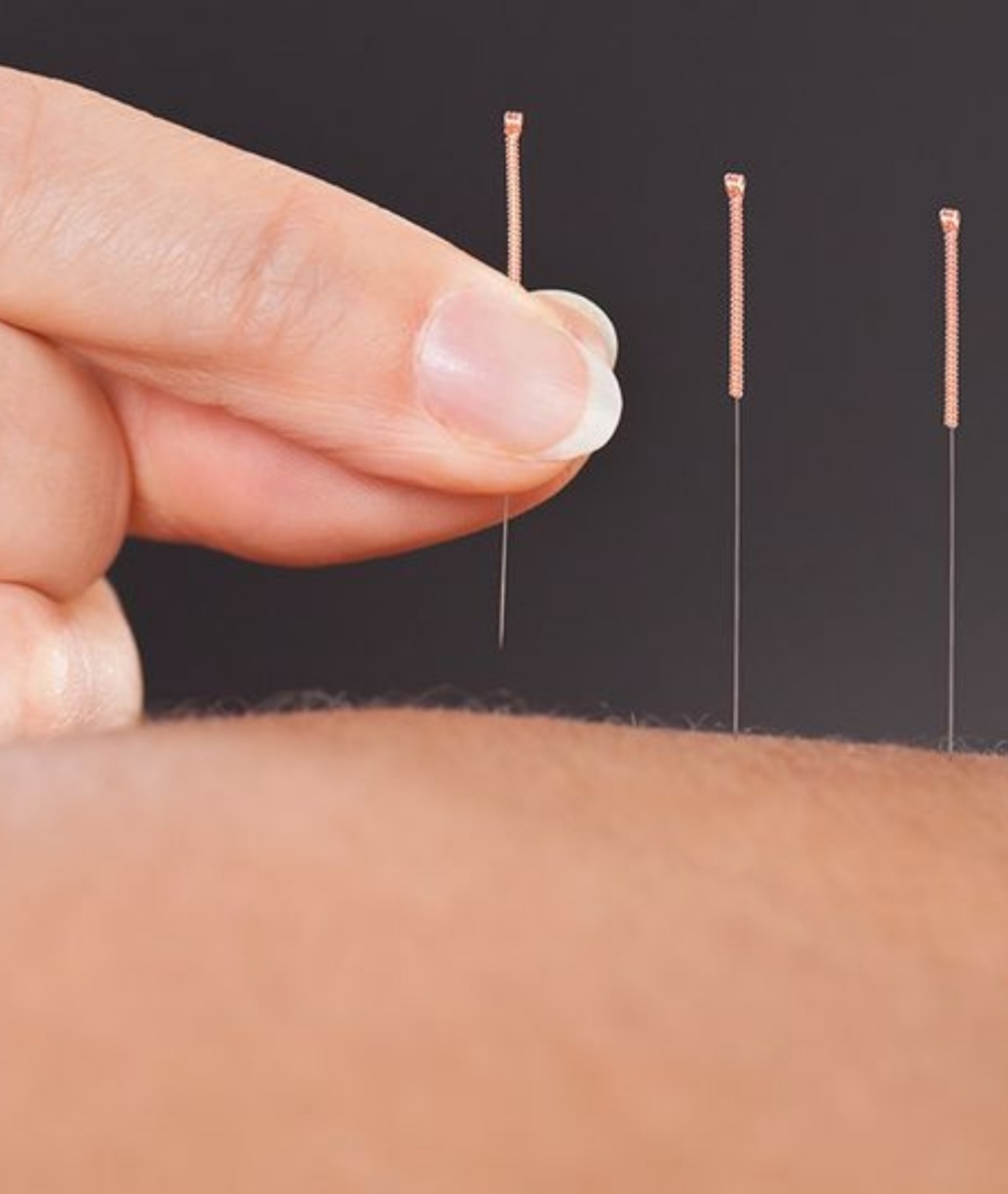 حجامت امبدینگ طب سوزنی در اصفهان