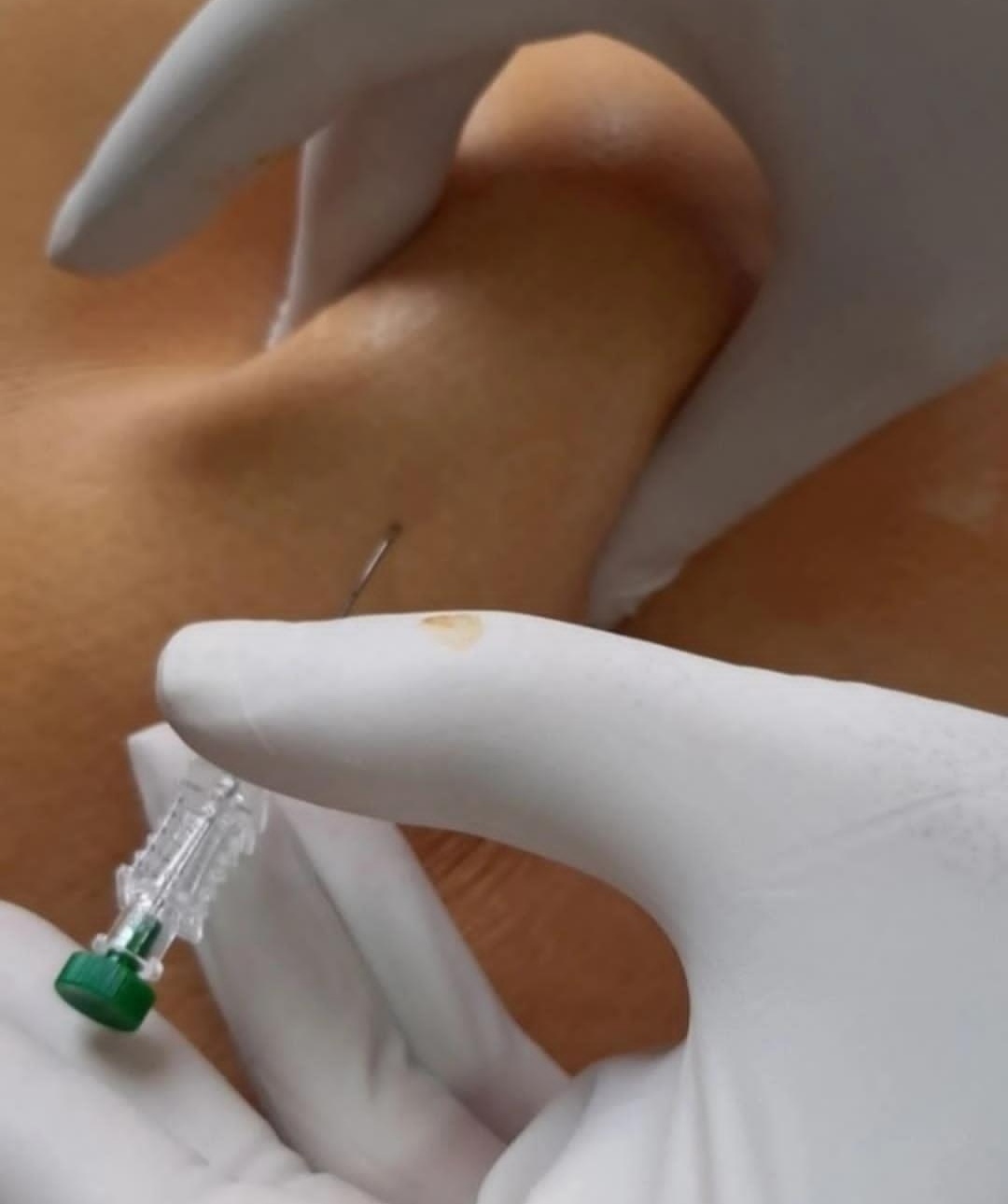 حجامت امبدینگ طب سوزنی در اصفهان