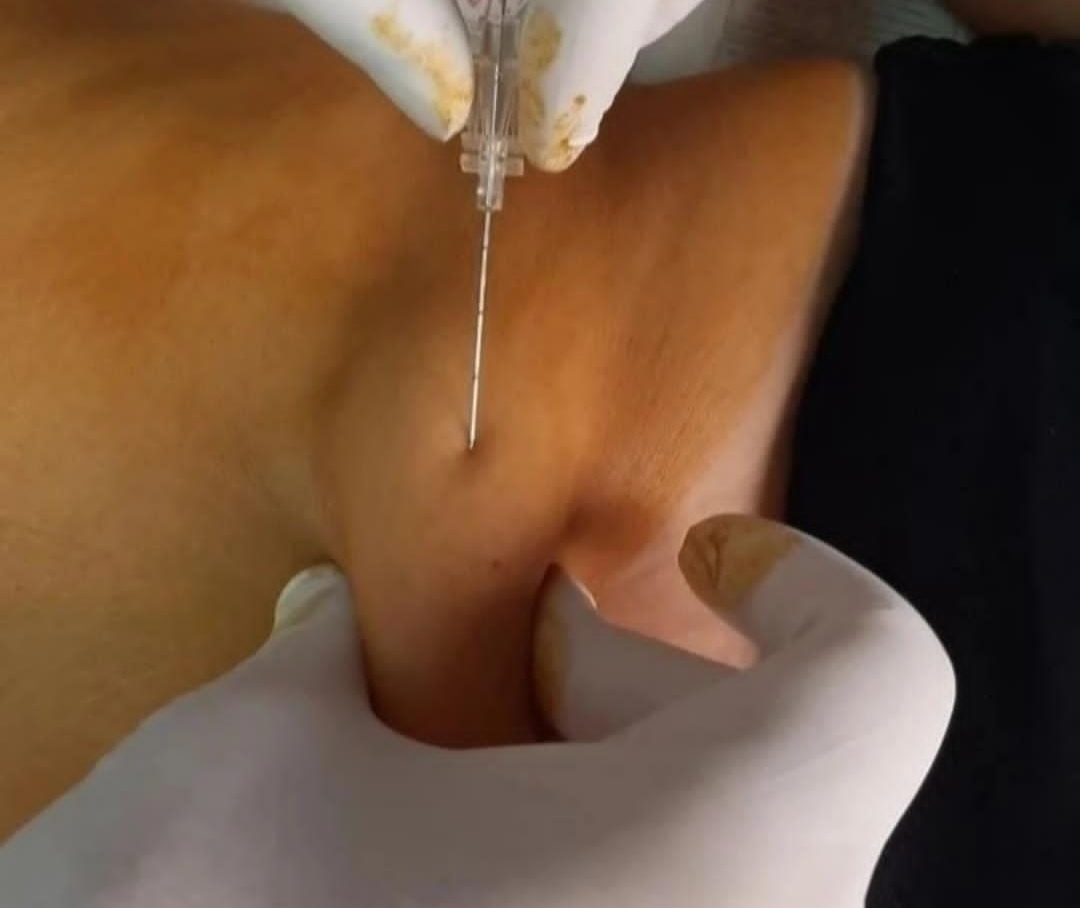 حجامت امبدینگ طب سوزنی در اصفهان