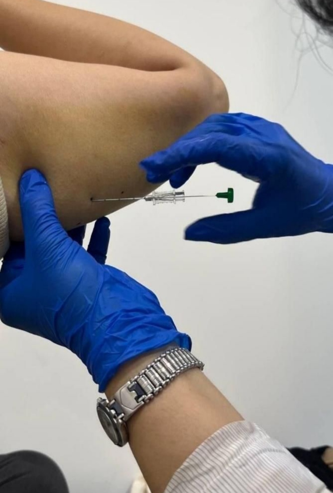 حجامت امبدینگ طب سوزنی در اصفهان