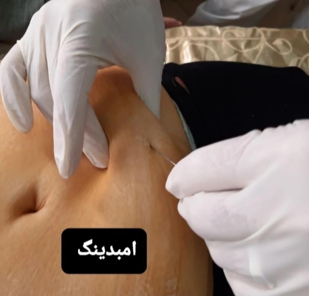 حجامت امبدینگ طب سوزنی در اصفهان