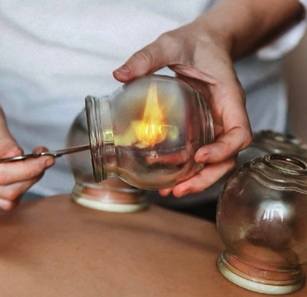 حجامت امبدینگ طب سوزنی در اصفهان