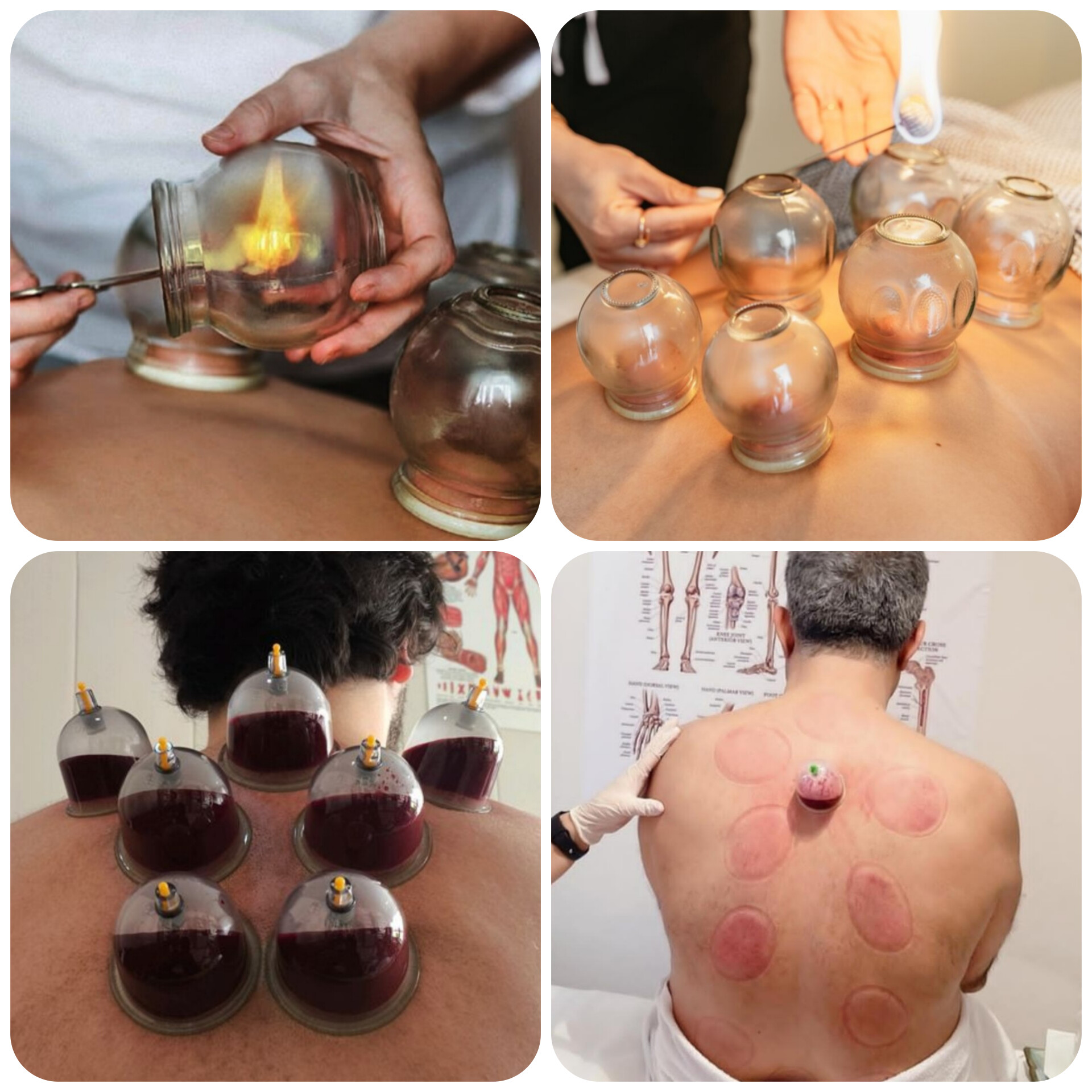 حجامت امبدینگ طب سوزنی در اصفهان