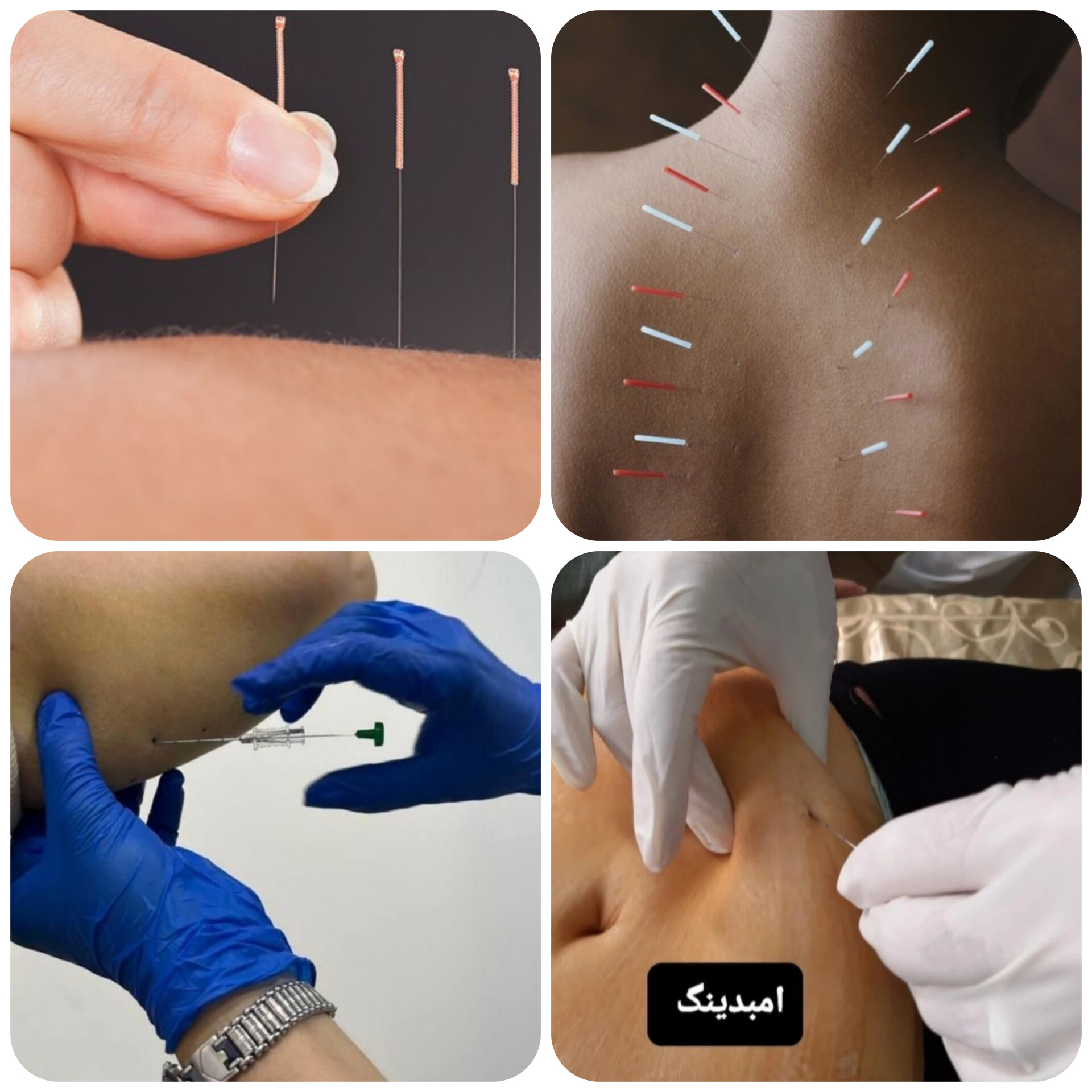 حجامت امبدینگ طب سوزنی در اصفهان