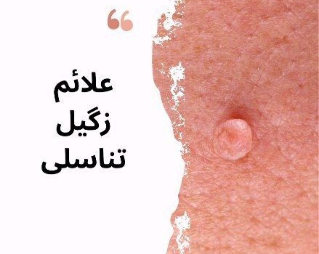 درمان زگیل تناسلی در اصفهان