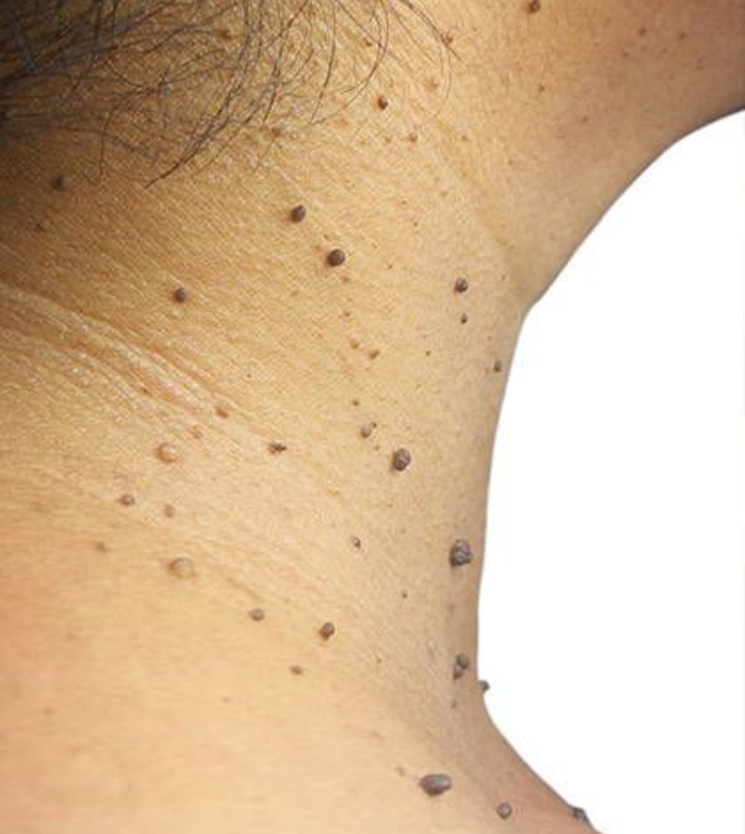 درمان زگیل تناسلی در اصفهان