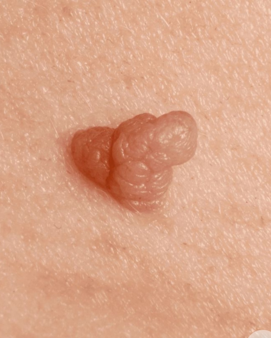 درمان زگیل تناسلی در اصفهان