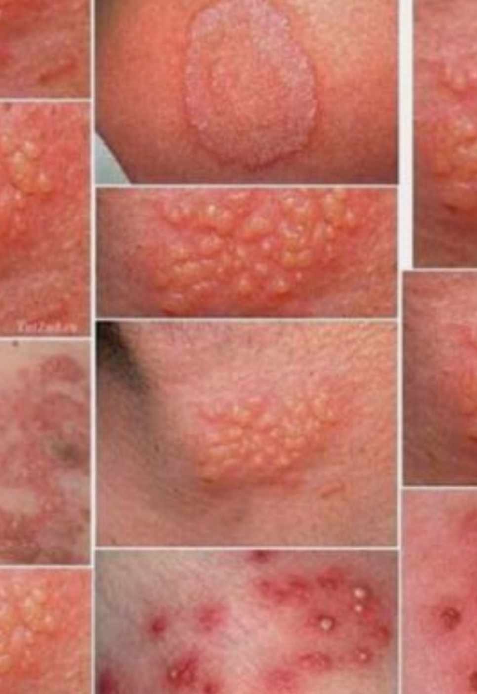 درمان قطعی زگیل تناسلی در اصفهان