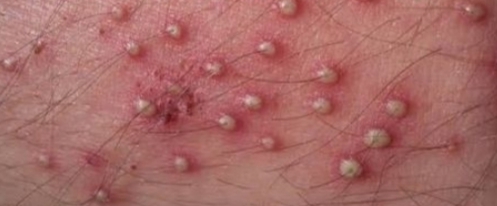 درمان قطعی زگیل تناسلی در اصفهان