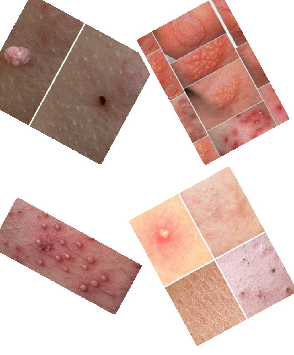 درمان قطعی زگیل تناسلی در اصفهان