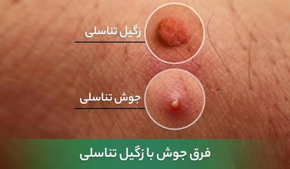 تفاوت جوش تناسلی با زگیل تناسلی