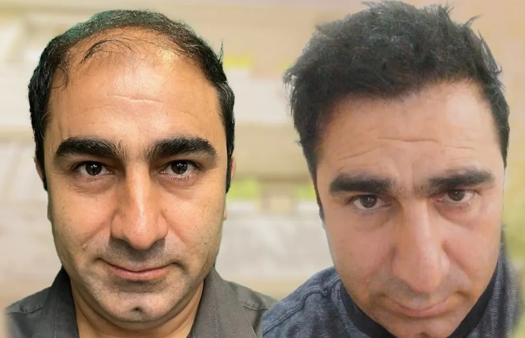بلفاروپلاستی،لیفت صورت،کاشت مو در اصفهان