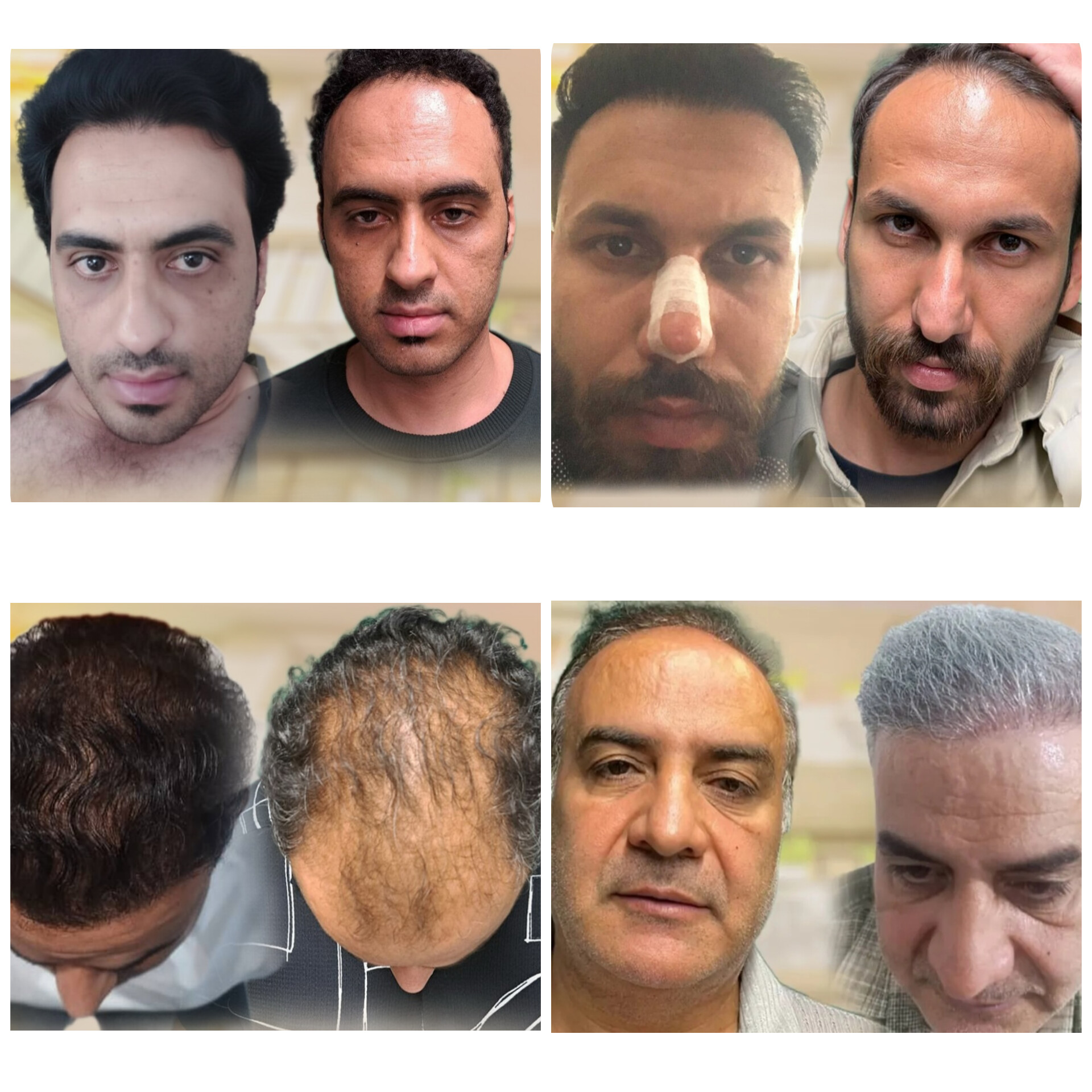 بلفاروپلاستی،لیفت صورت،کاشت مو در اصفهان 