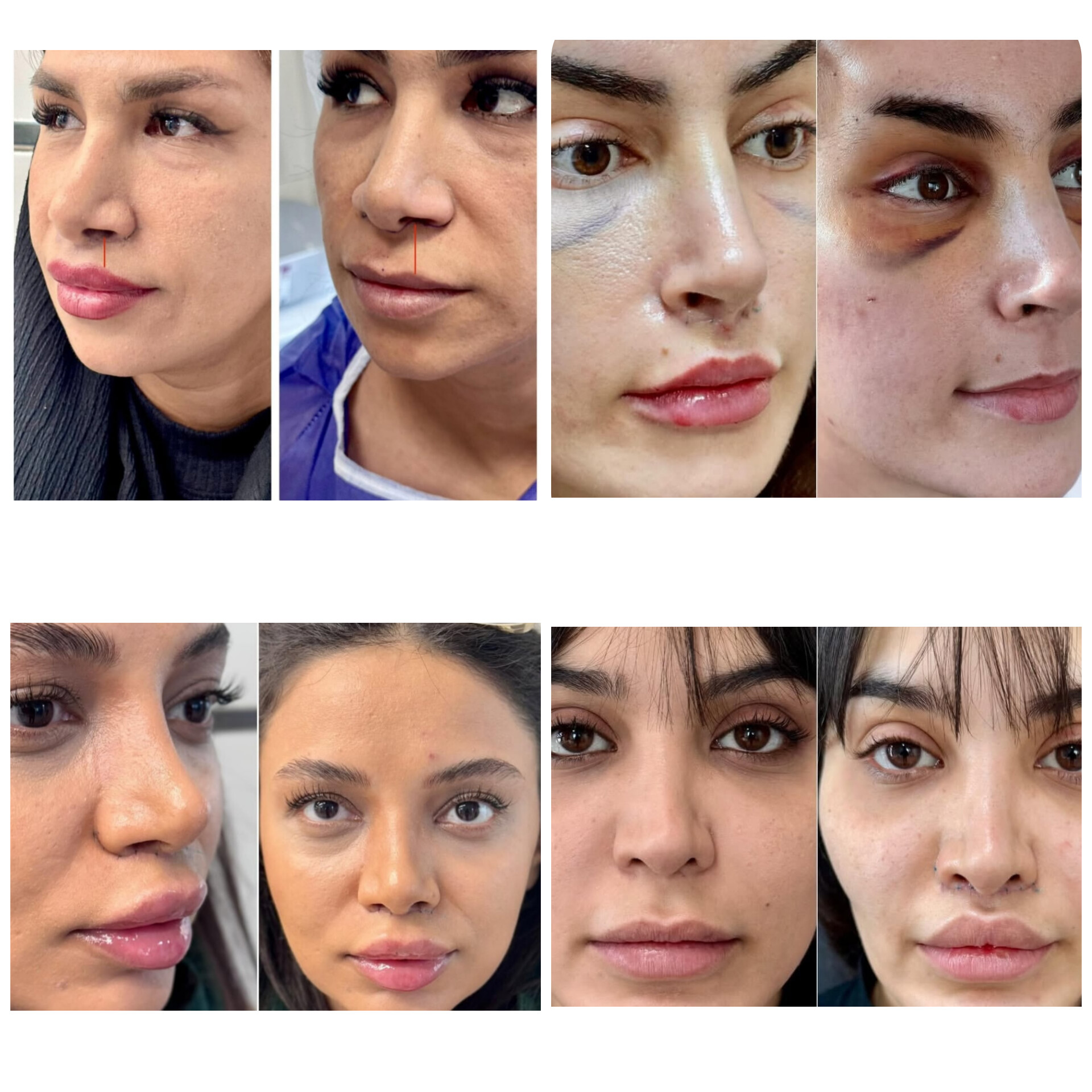 بلفاروپلاستی،لیفت صورت،کاشت مو در اصفهان 