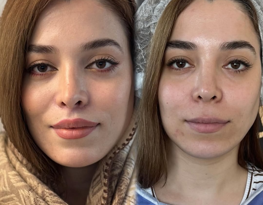بلفاروپلاستی،لیفت صورت،کاشت مو در اصفهان