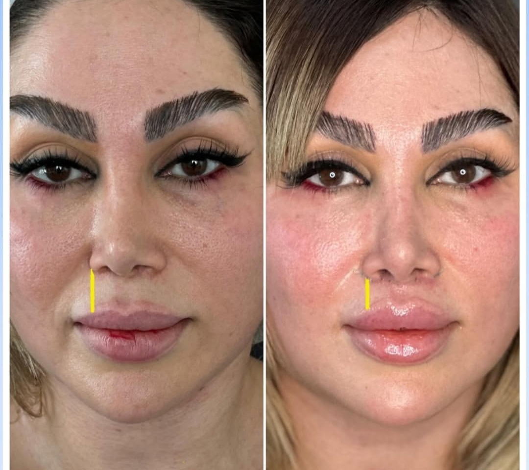بلفاروپلاستی،لیفت صورت،کاشت مو در اصفهان