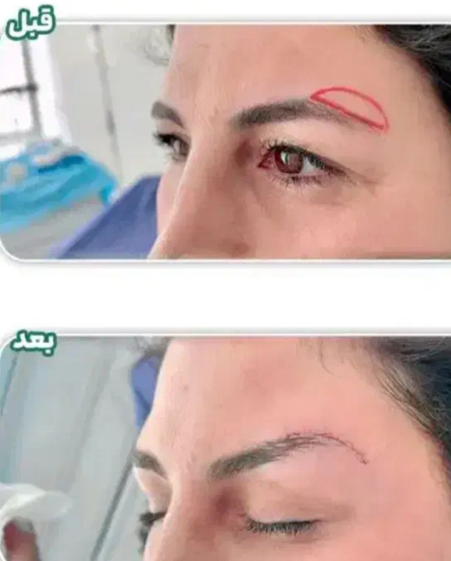 بلفاروپلاستی،لیفت صورت،کاشت مو در اصفهان