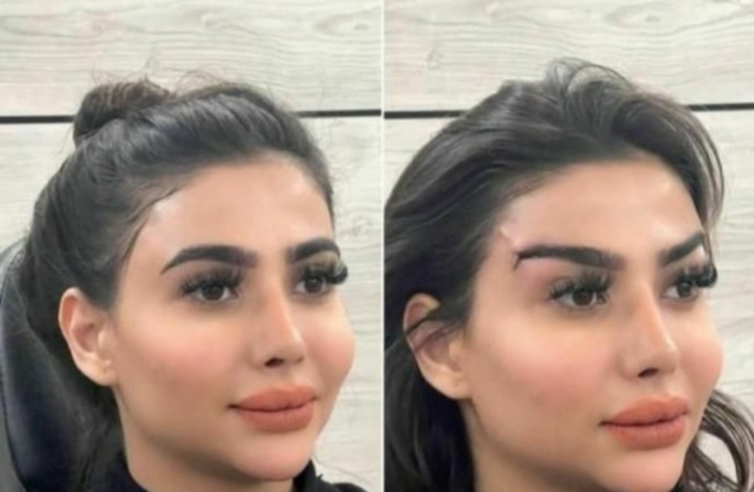 بلفاروپلاستی،لیفت صورت،کاشت مو در اصفهان 