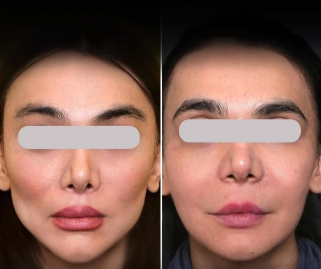 بلفاروپلاستی،لیفت صورت،کاشت مو در اصفهان 
