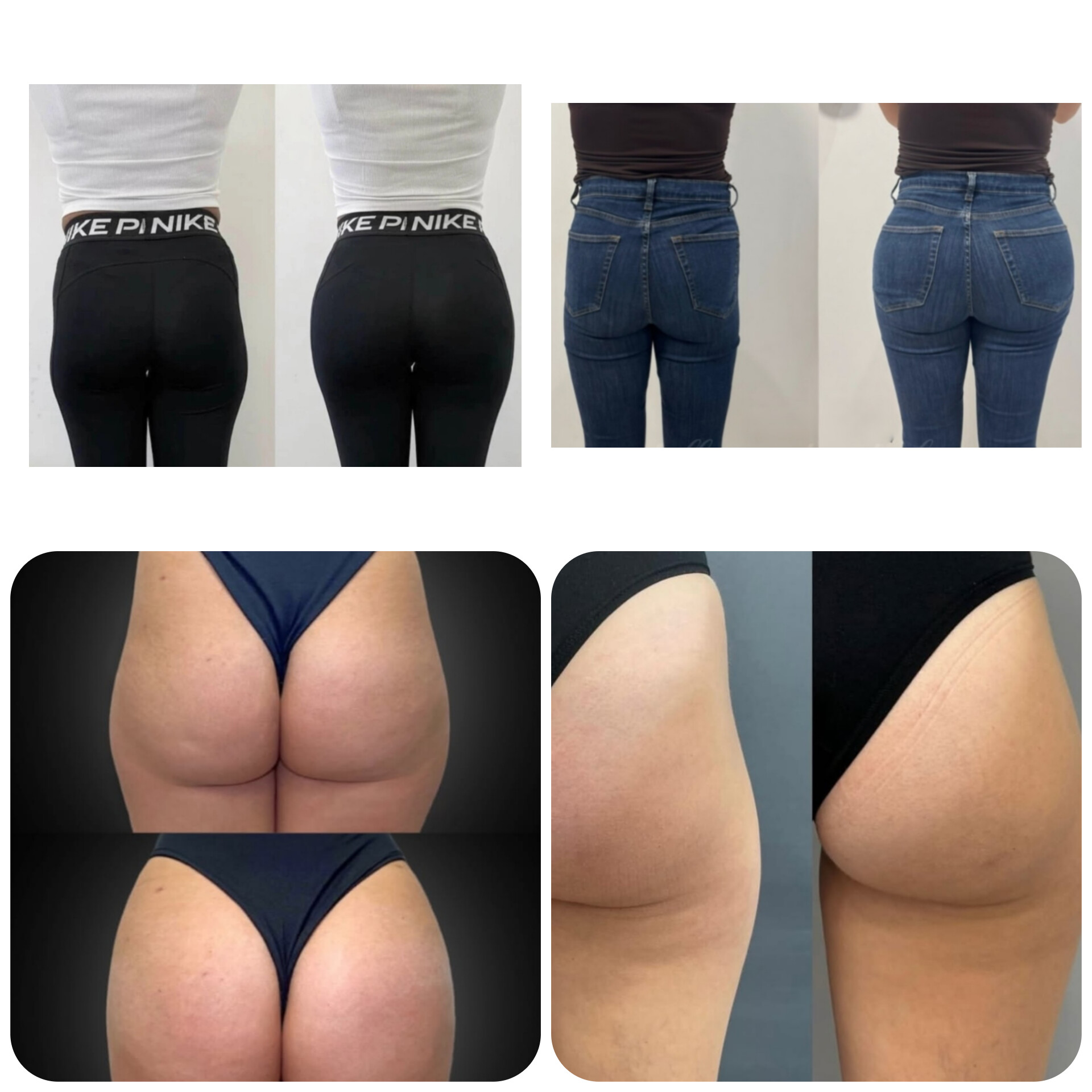 فیلر بادی بوتاکس در اصفهان 