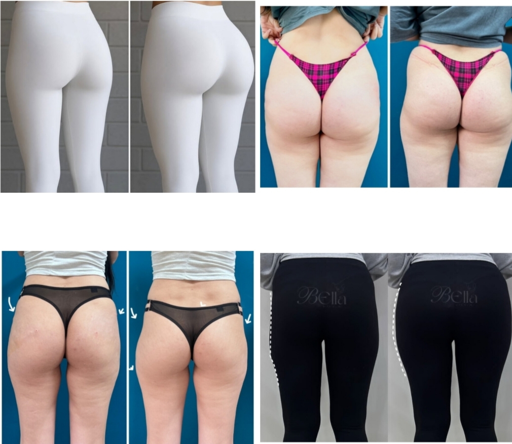 فیلر بادی بوتاکس در اصفهان 