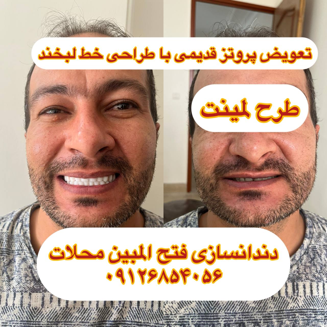دندان مصنوعی بدون سقف