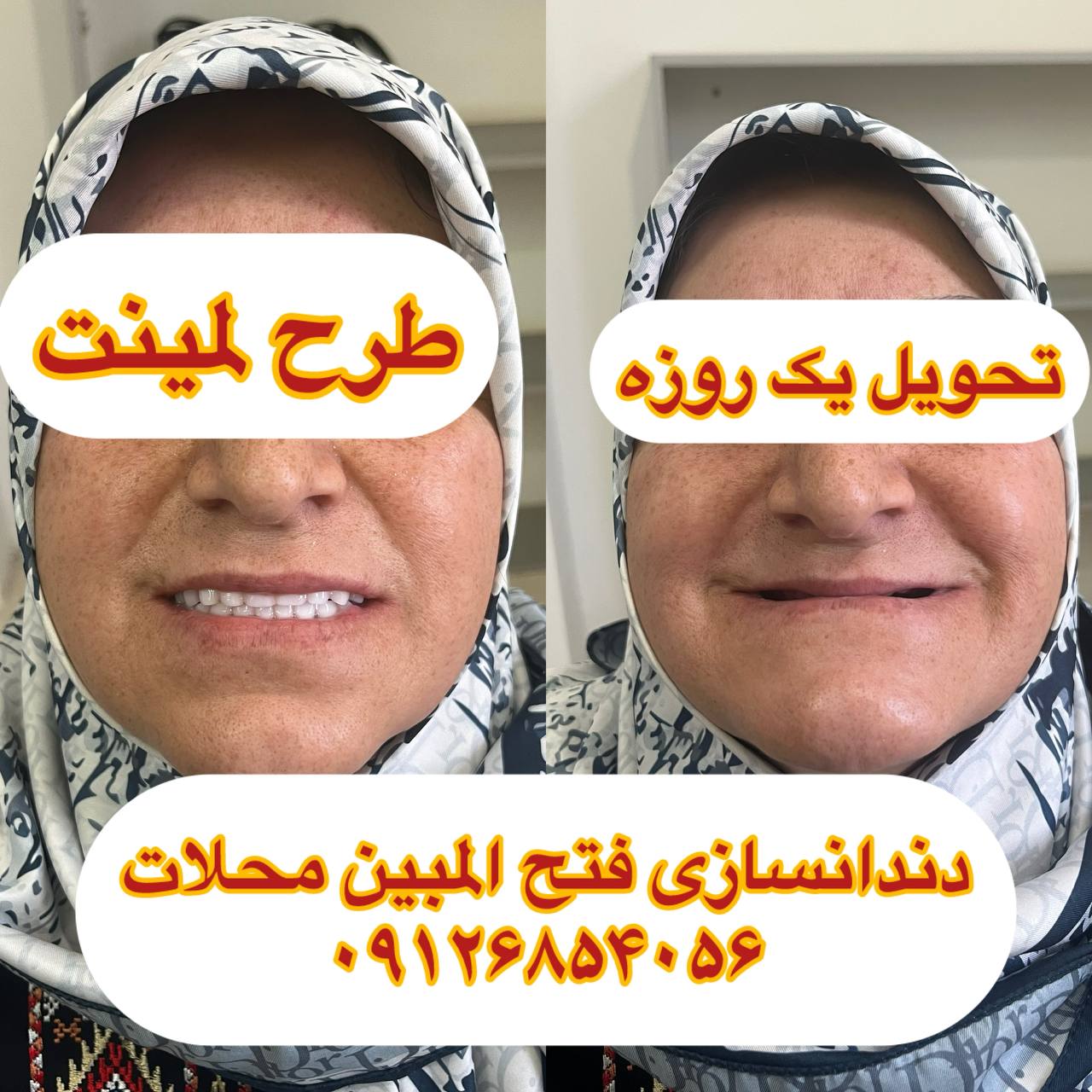دندان مصنوعی طرح لمینت