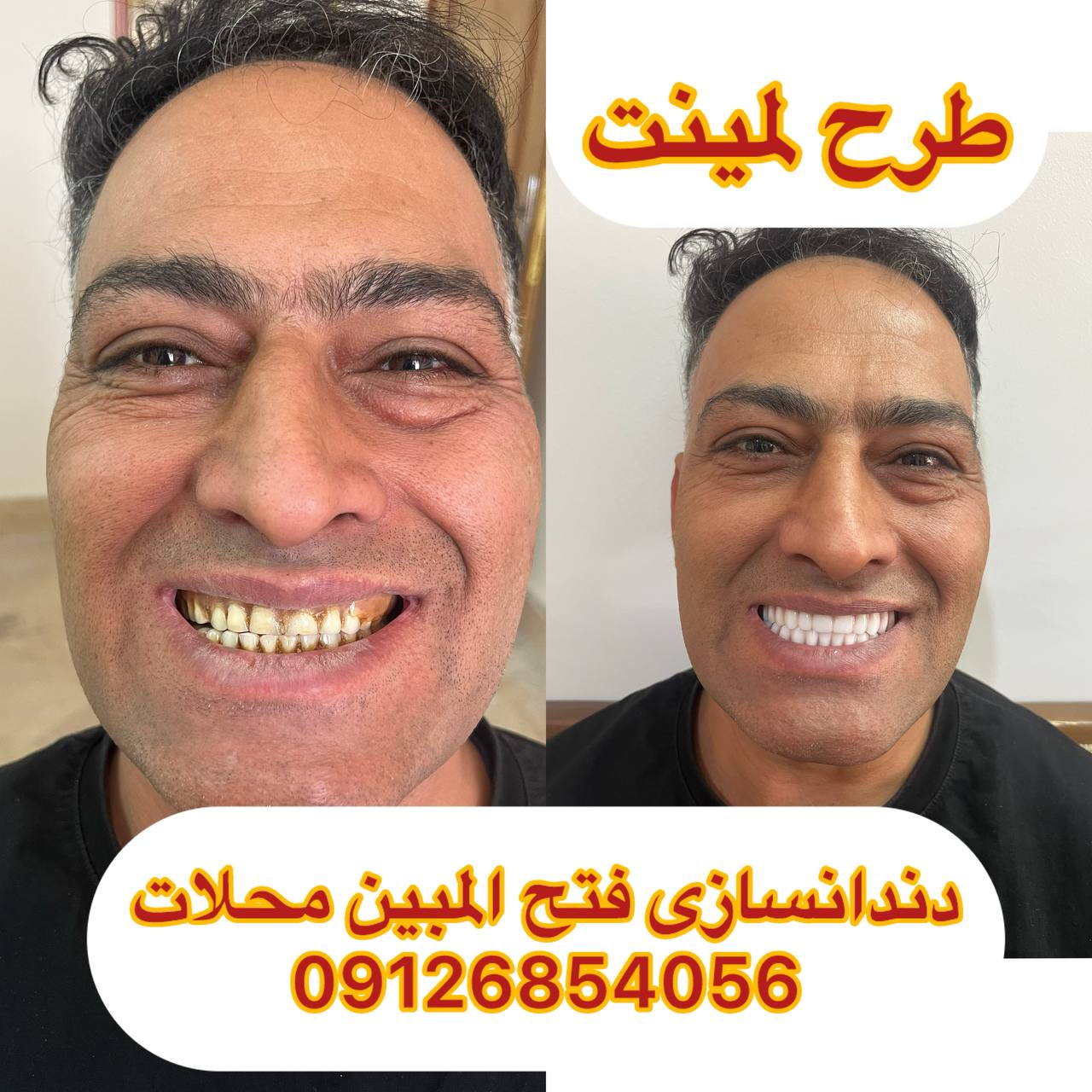 دندانسازی فوری محلات