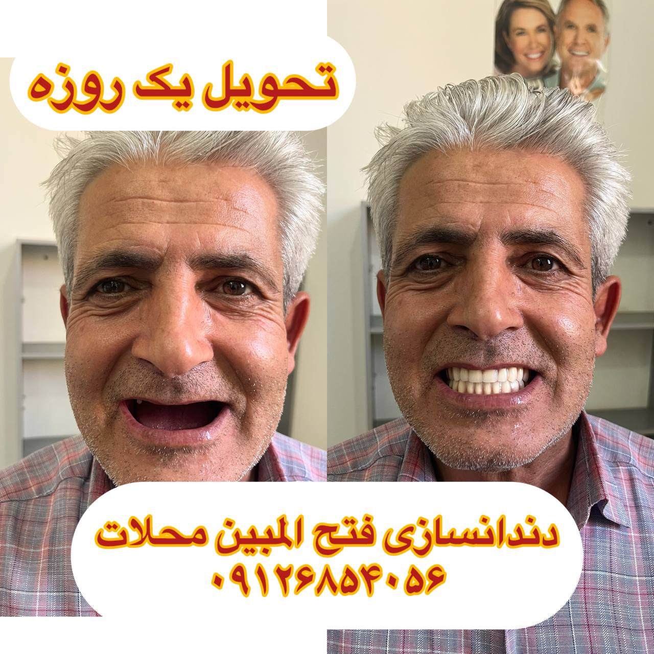 دندان مصنوعی ژله ای در محلات