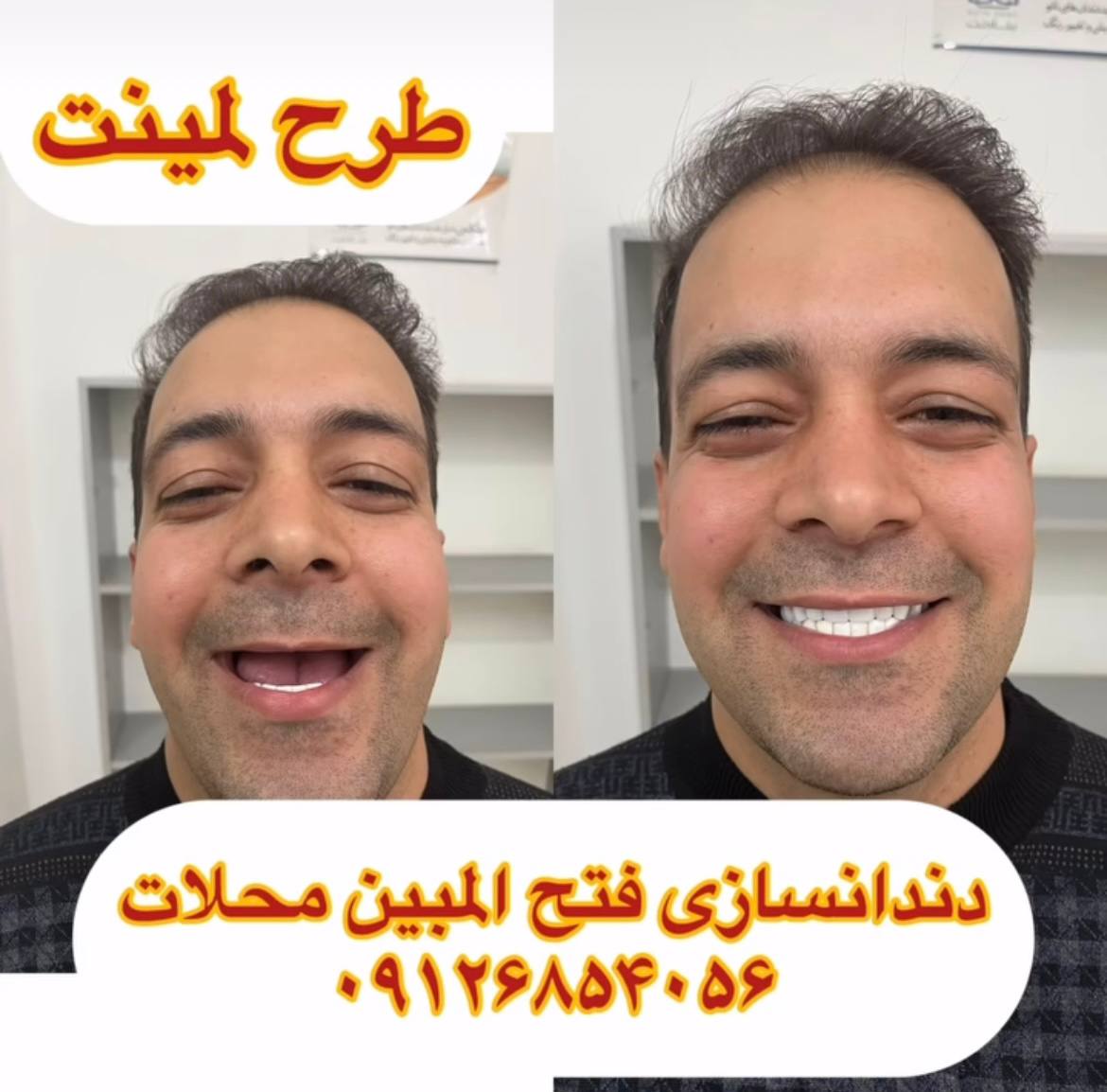 ساخت دندان مصنوعی در محلات
