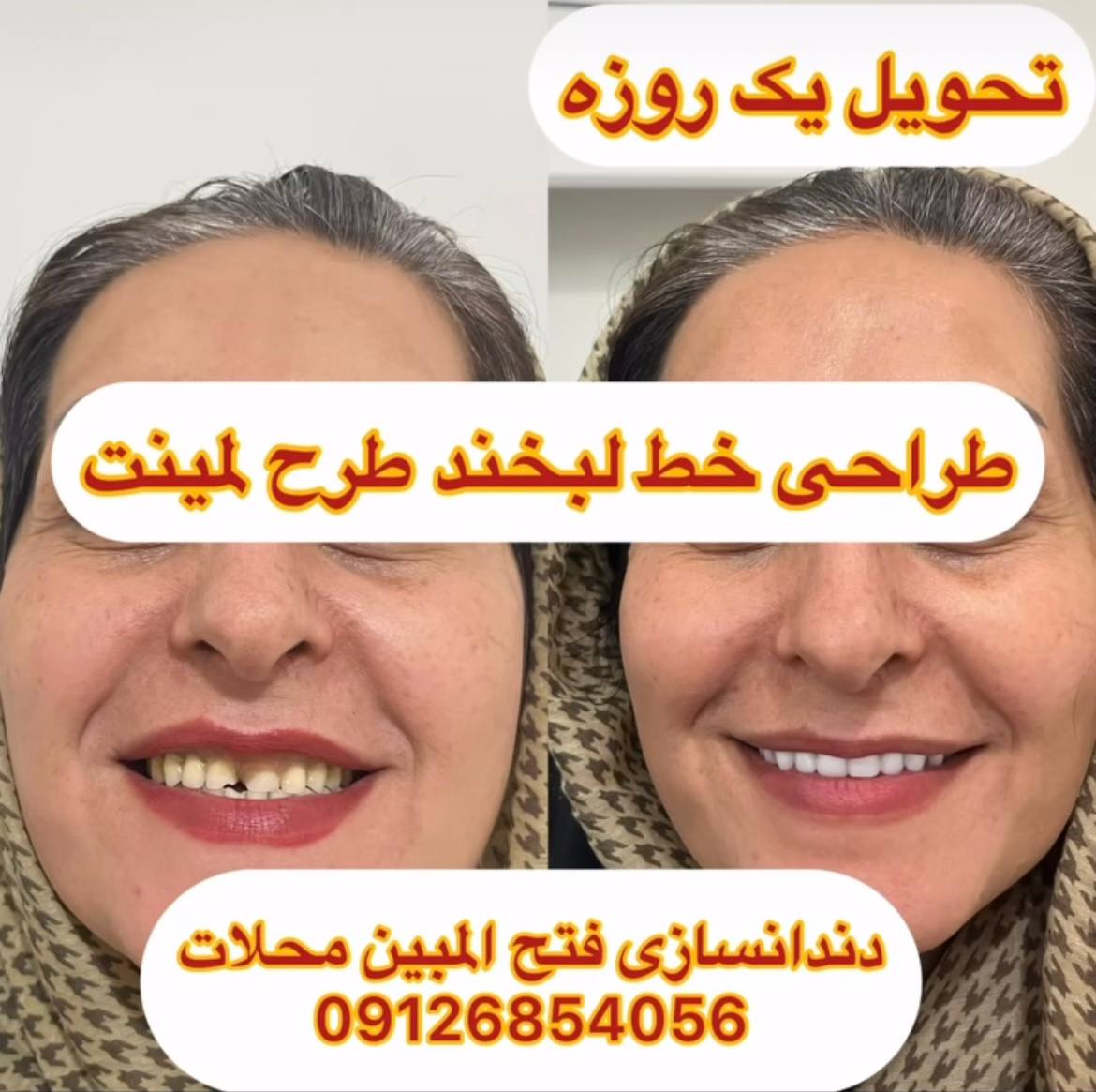 دندان مصنوعی ژله ای در محلات