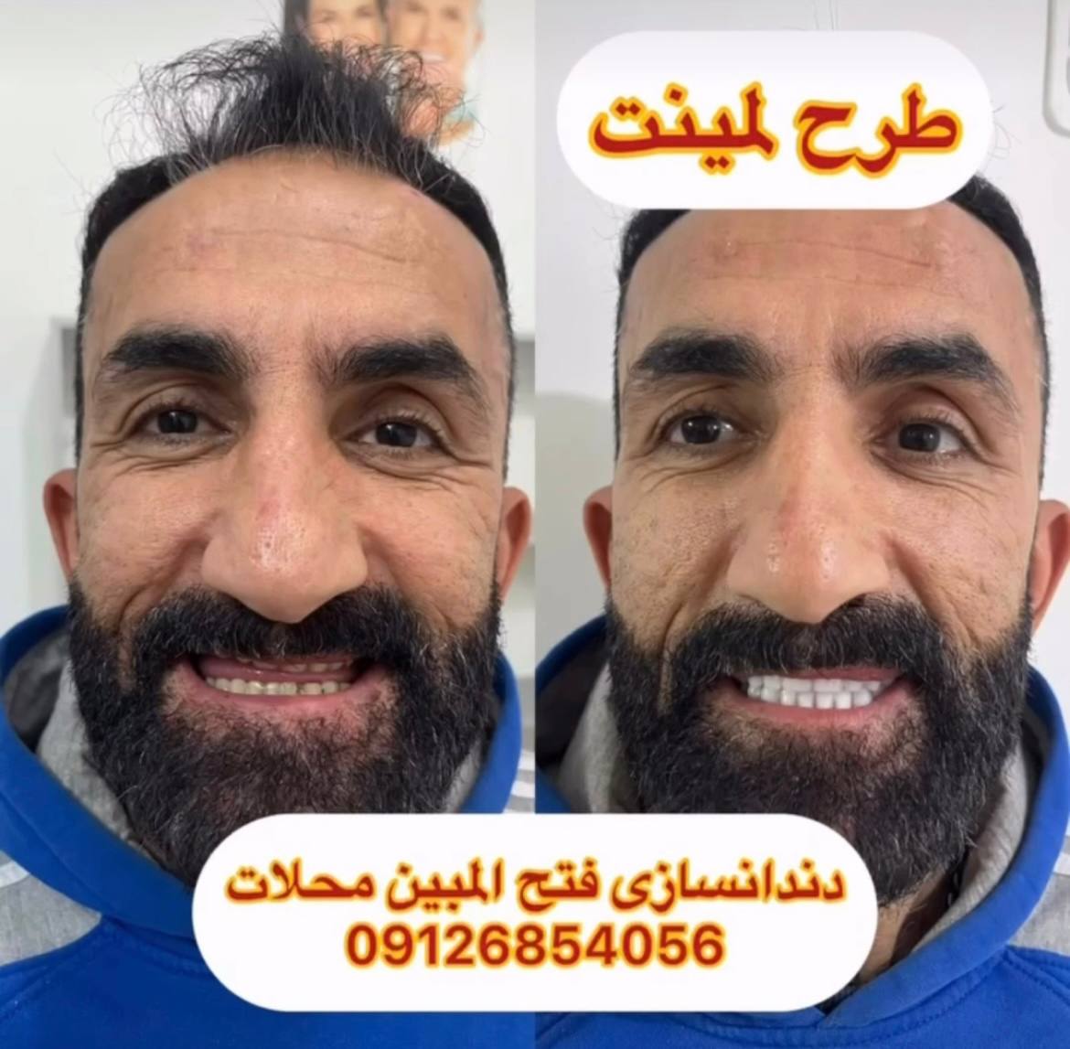 قیمت دندان مصنوعی در محلات