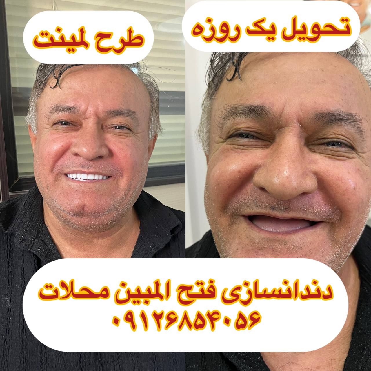 قیمت دندان مصنوعی در محلات