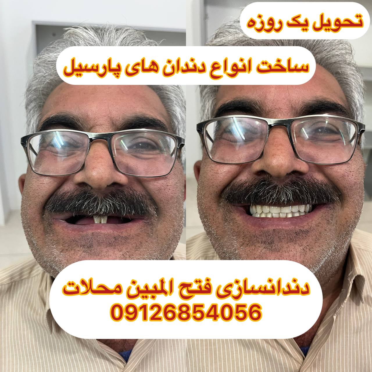 لیست قیمت دندان مصنوعی در محلات