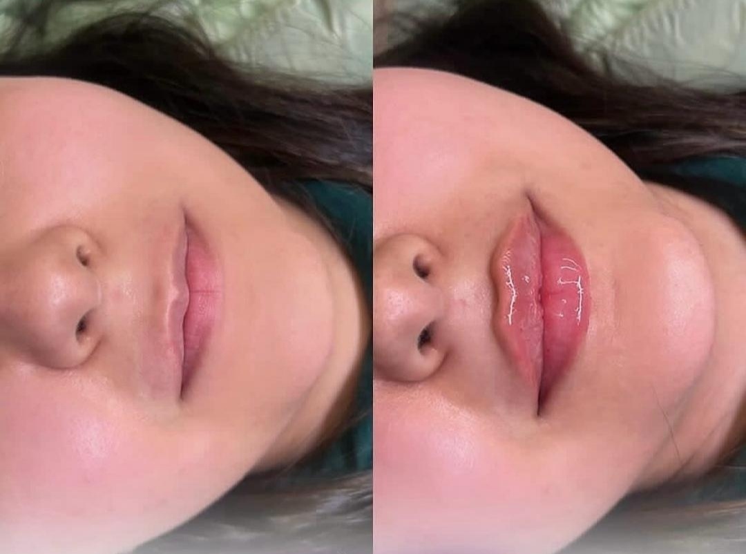 تزریق فیلرزیرچشم بینی لب دراصفهان