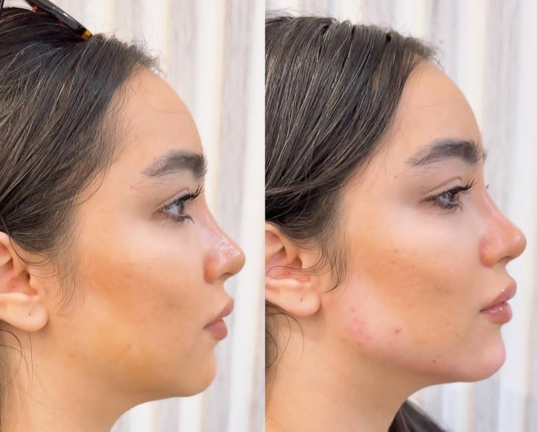 تزریق فیلرزیرچشم بینی لب دراصفهان