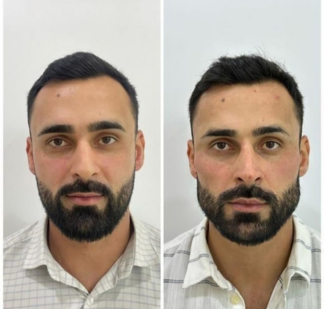 تزریق مادلینگ فول فیس