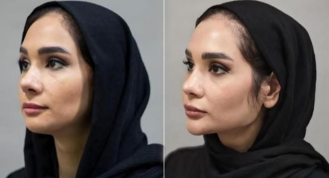 تزریق فیلر زیر چشم بینی لب دراصفهان