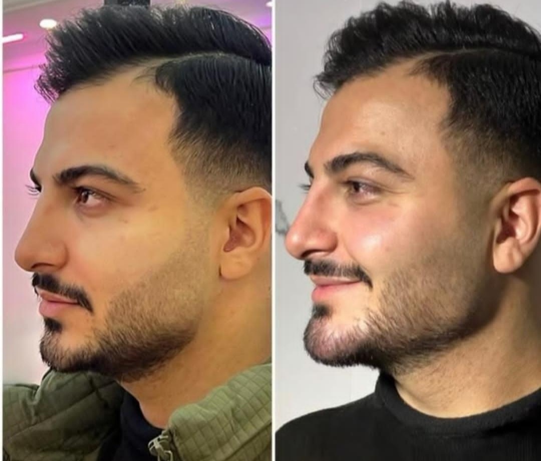 تزریق مادلینگ فول فیس