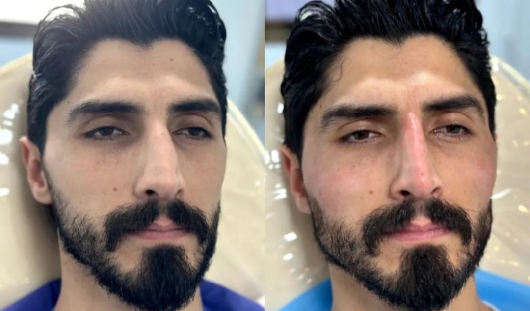تزریق فیلر زاویه فک دراصفهان