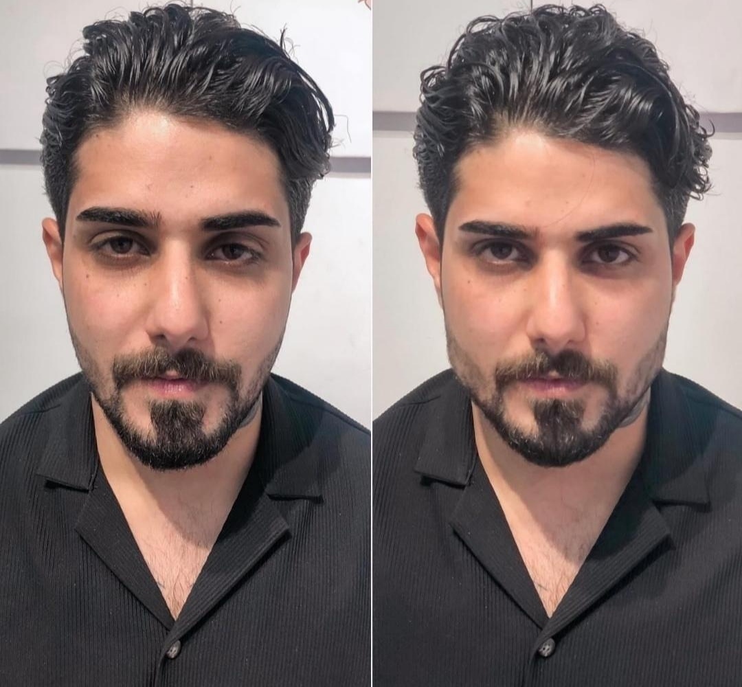 تزریق مادلینگ فول فیس