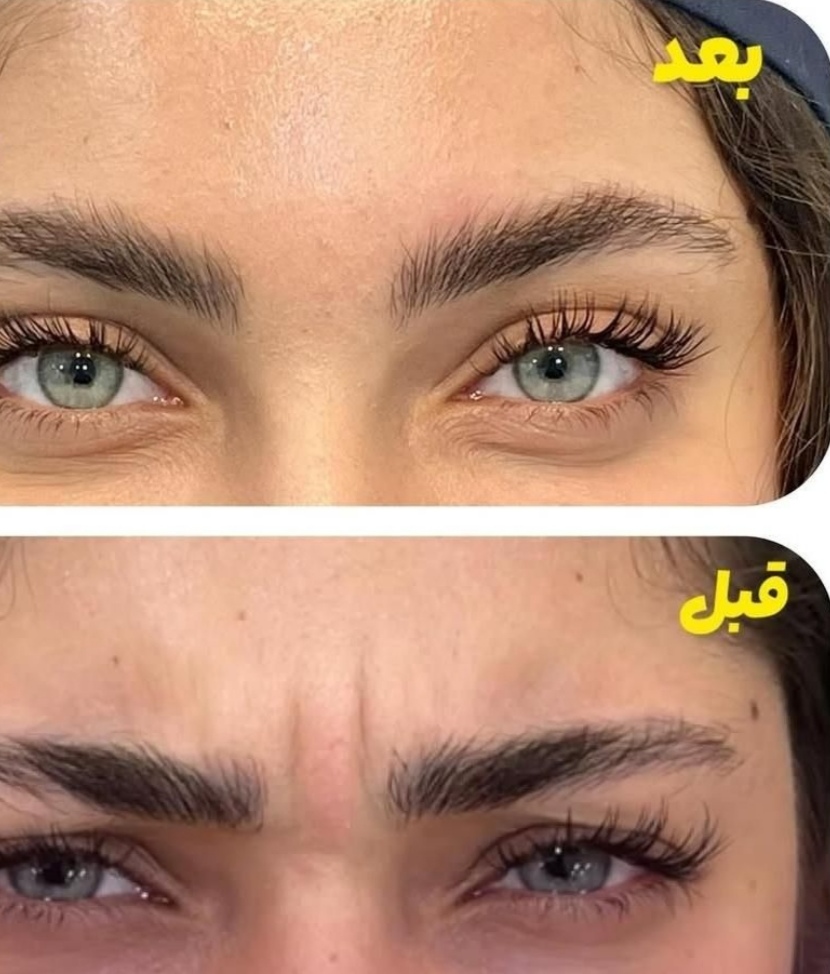 تزریق فیلر و بوتاکس در اصفهان 