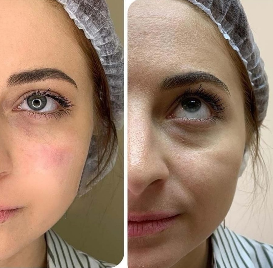 تزریق فیلر و بوتاکس در اصفهان 