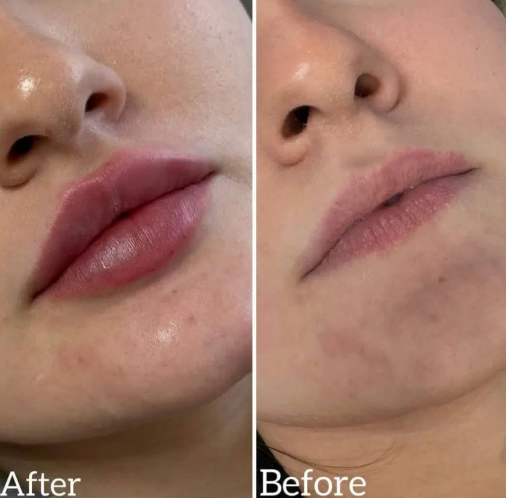 تزریق فیلر و بوتاکس در اصفهان 