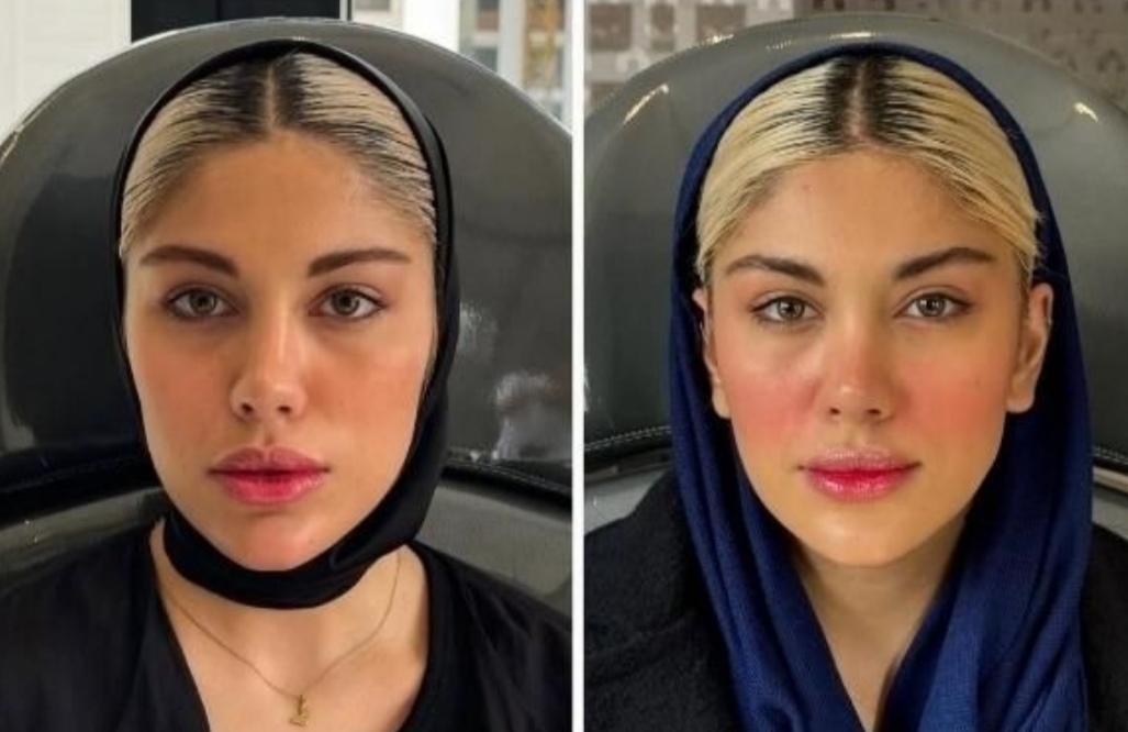 تزریق مادلینگ فول فیس