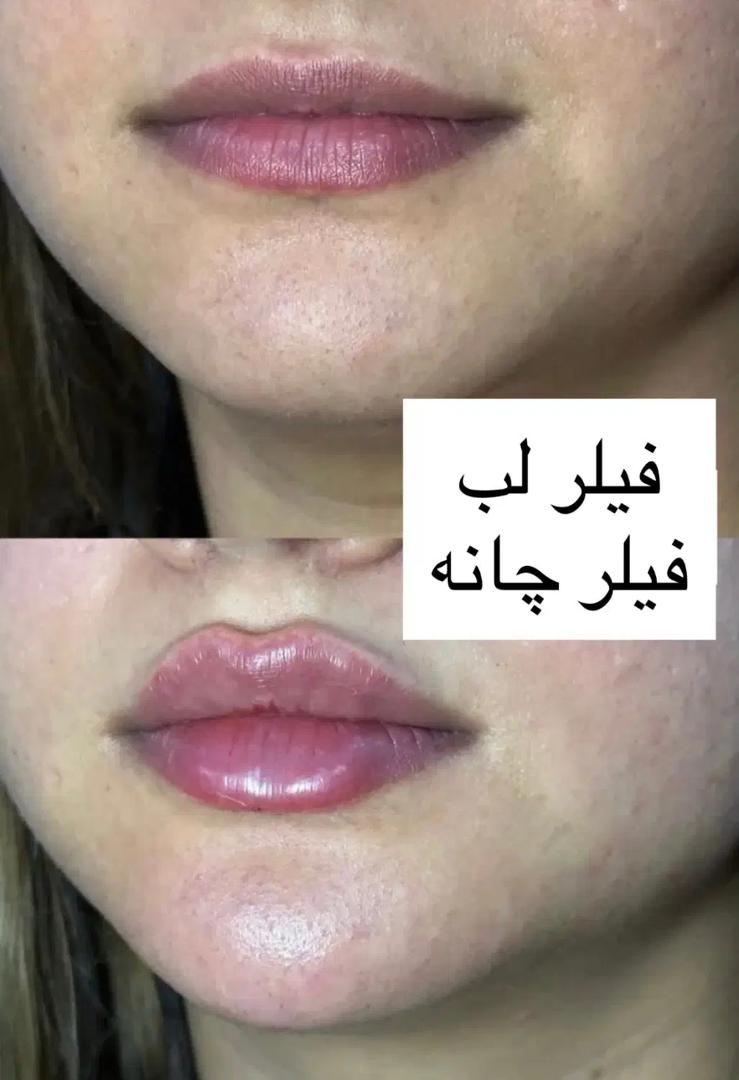 تزریق فیلر زیر چشم بینی لب در اصفهان