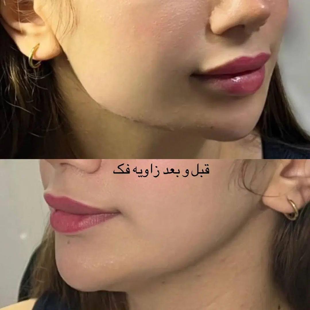 تزریق فیلر زیر چشم بینی لب در اصفهان