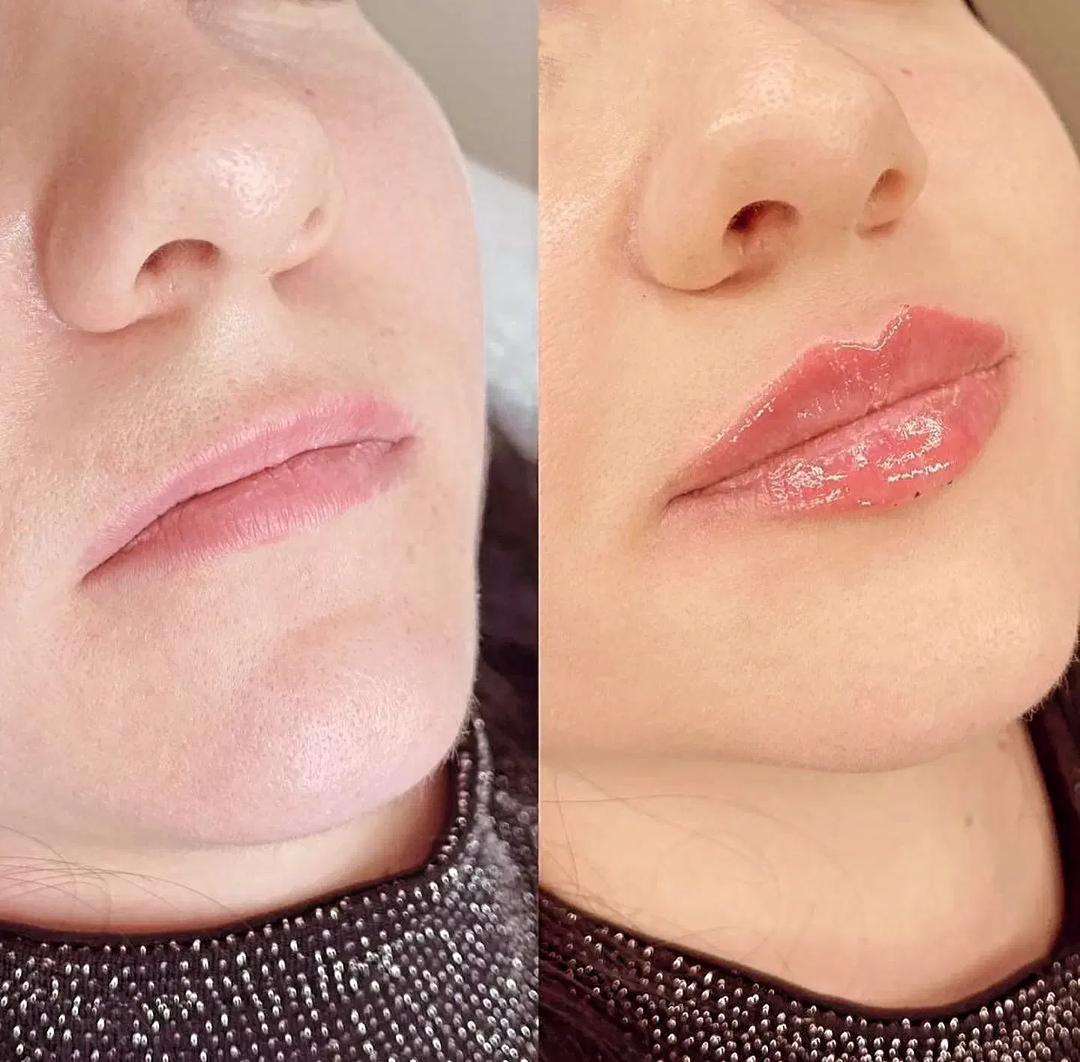 تزریق فیلر زیر چشم بینی لب در اصفهان