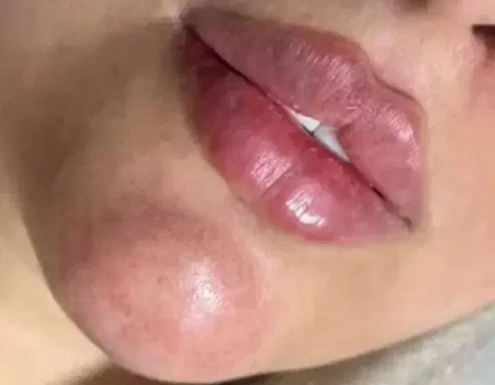 تزریق فیلر زیر چشم بینی لب در اصفهان